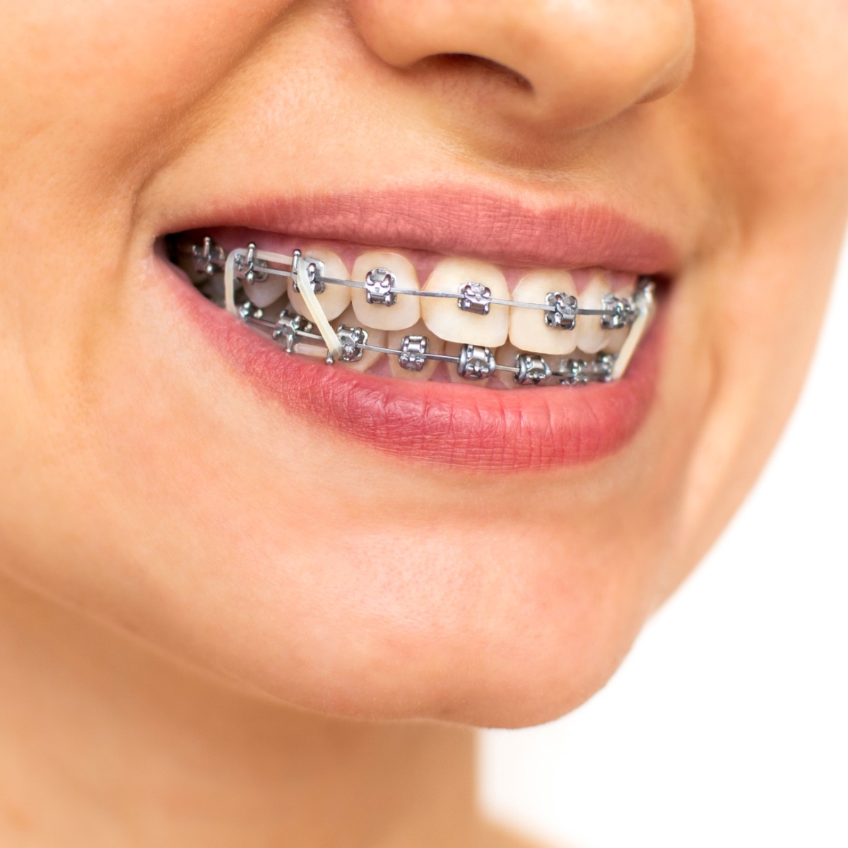 Why You Should Wear Elastics With Your Houston Braces